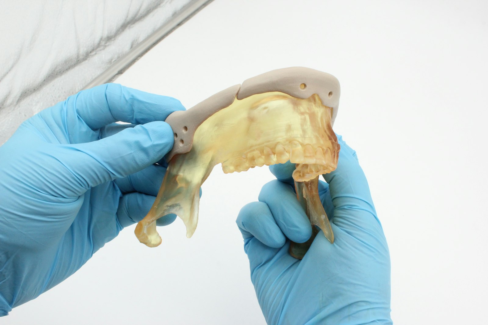 Guia cirúrgico impresso em 3D