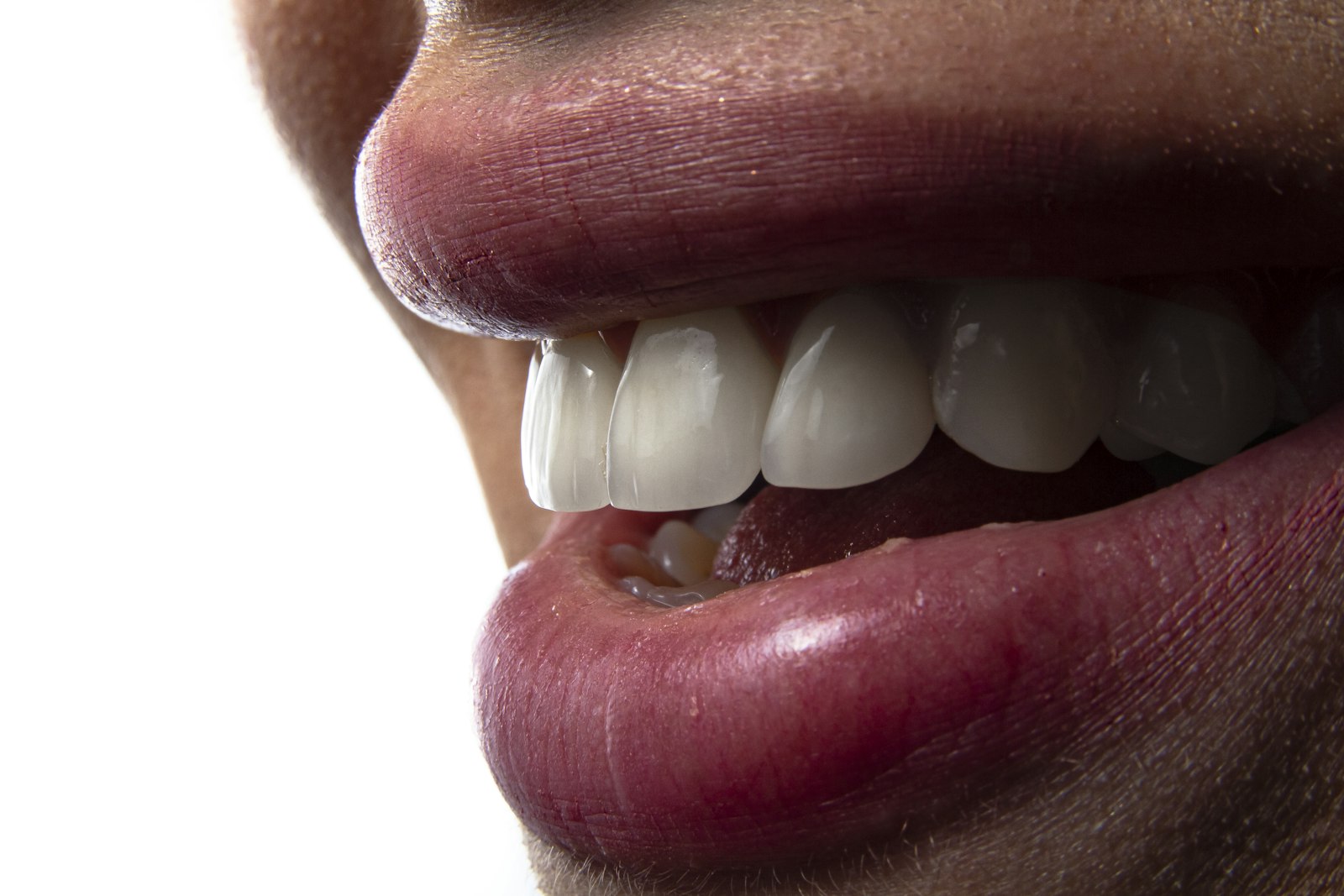 Sorriso reabilitado com implantes